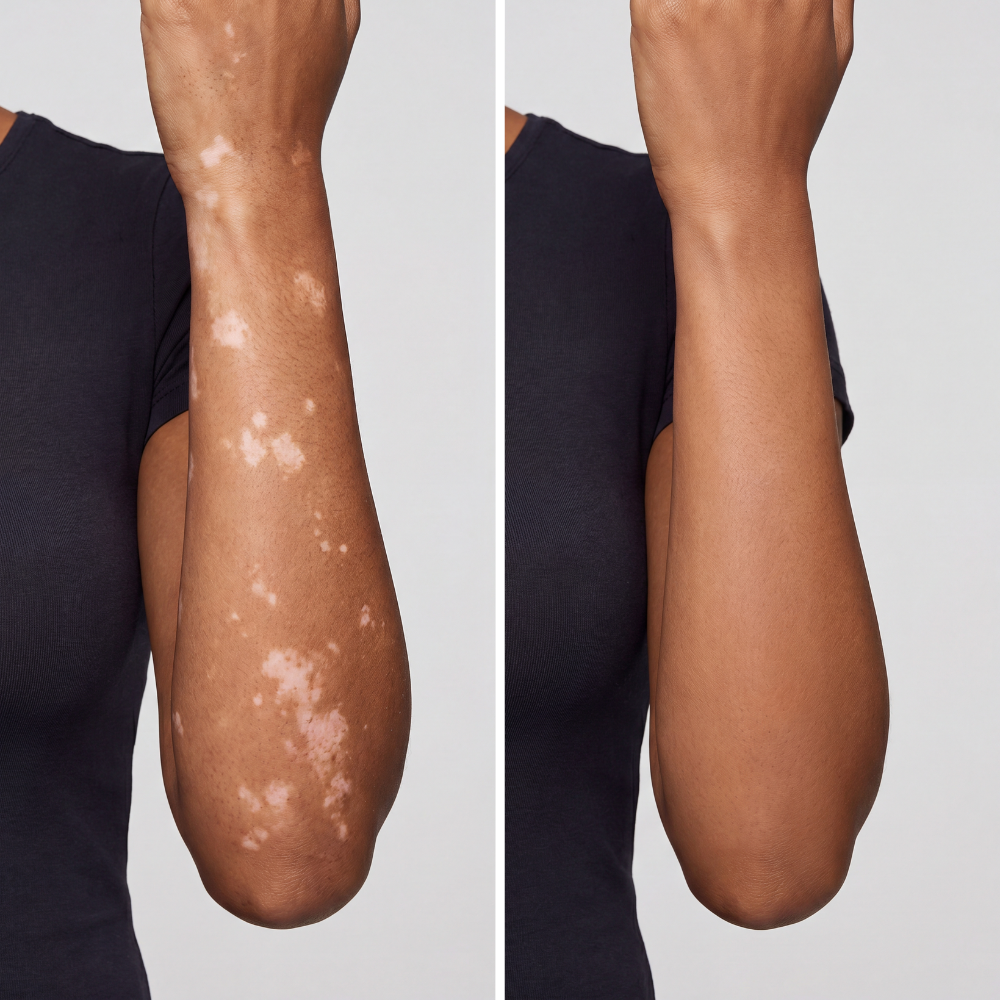 Vitiligo