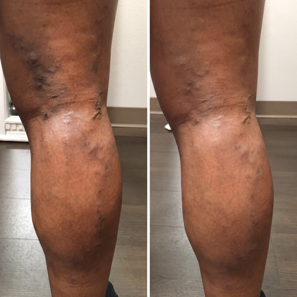 Varicose Veins